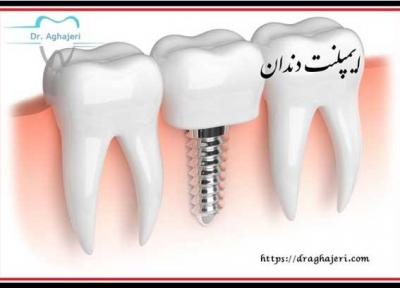 از سیر تا پیاز ایمپلنت دندان !!