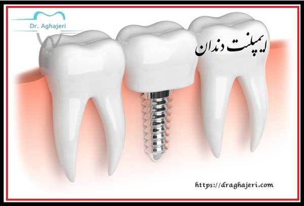 از سیر تا پیاز ایمپلنت دندان !!