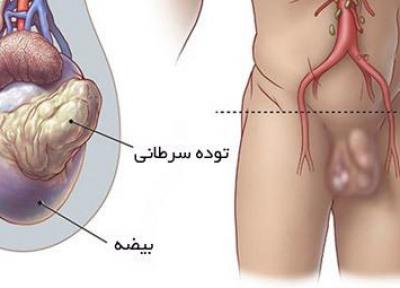 علائم سرطان بیضه چیست؟