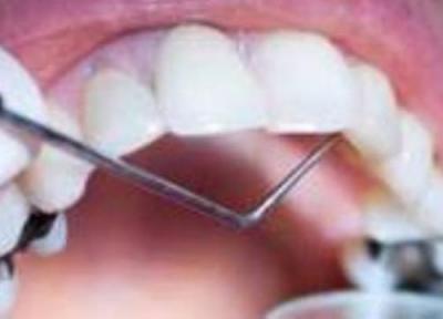 غذاهای دندان شکن