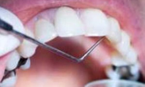 غذاهای دندان شکن